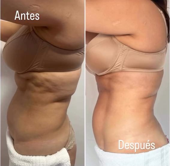 Antes y después de un tratamiento corporal, vista lateral del abdomen