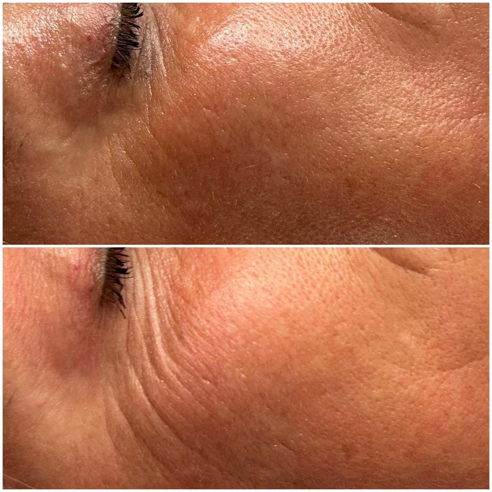 Antes y después de un tratamiento facial para líneas de expresión en el contorno del ojo
